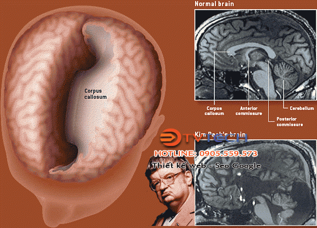 Hình chụp bán cầu não của Peer